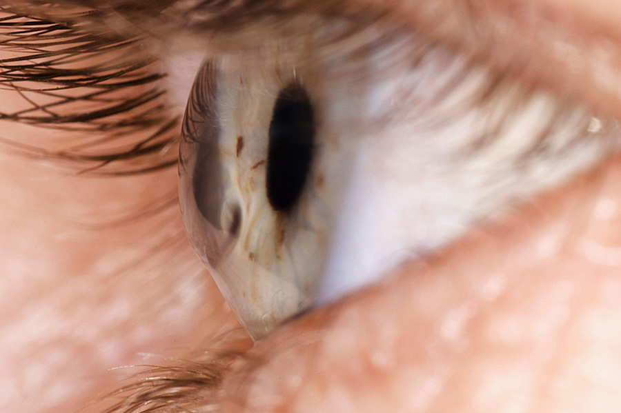 keratoconus_blog